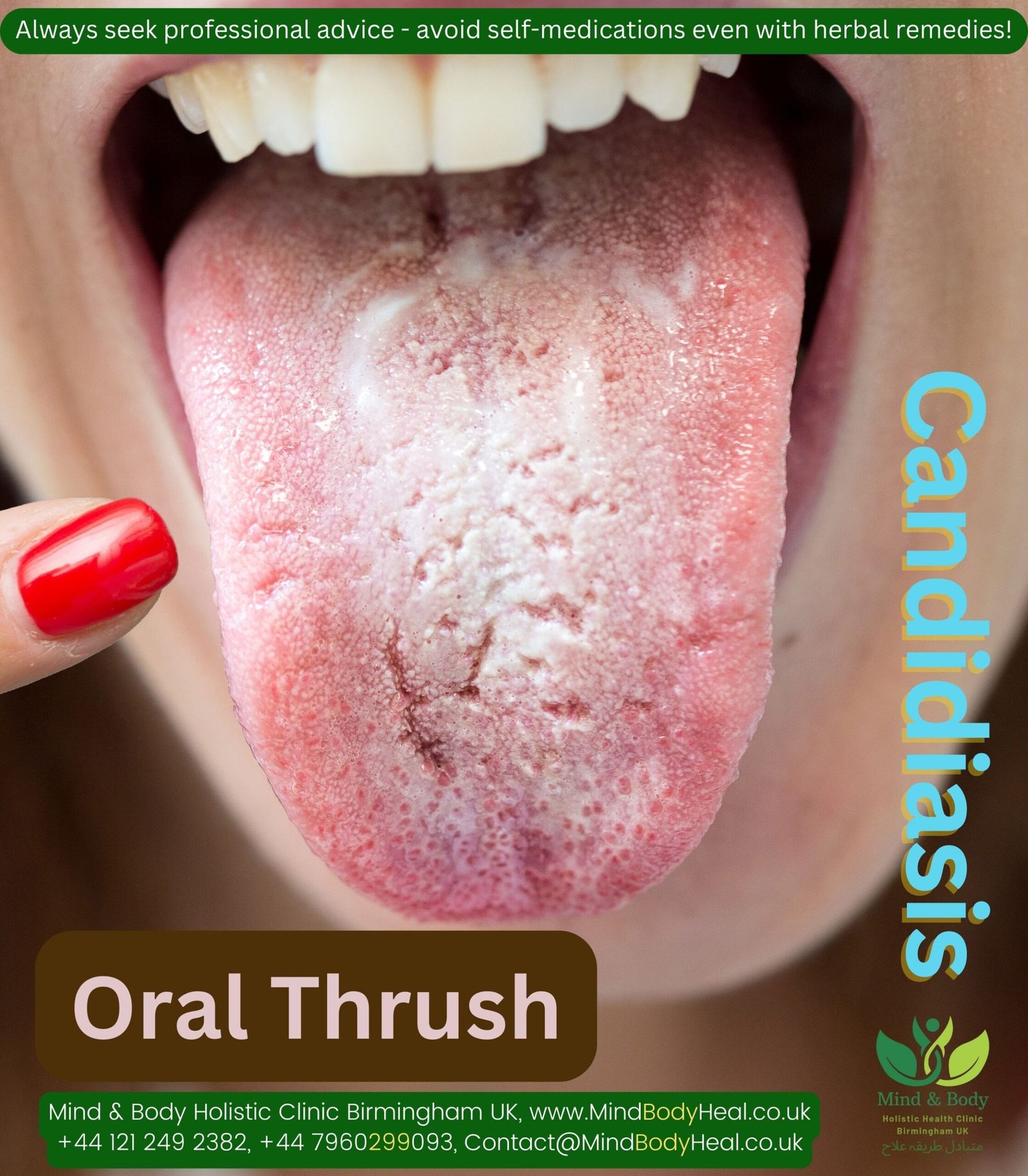 Oral Thrush Medication