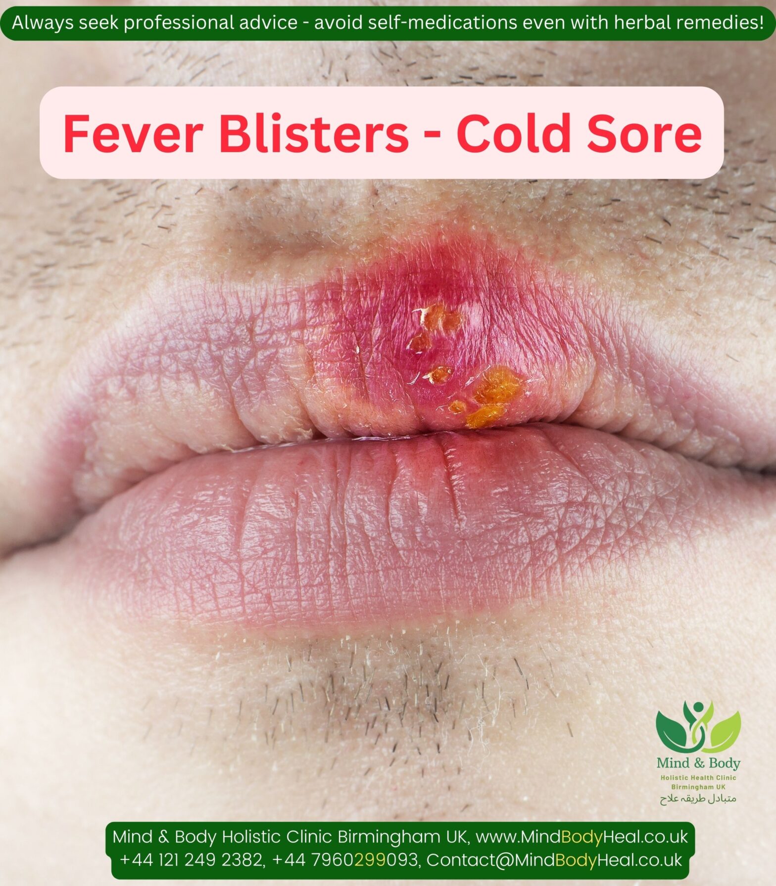 Recurrent Cold sores / Fever blisters Suggested complimentary