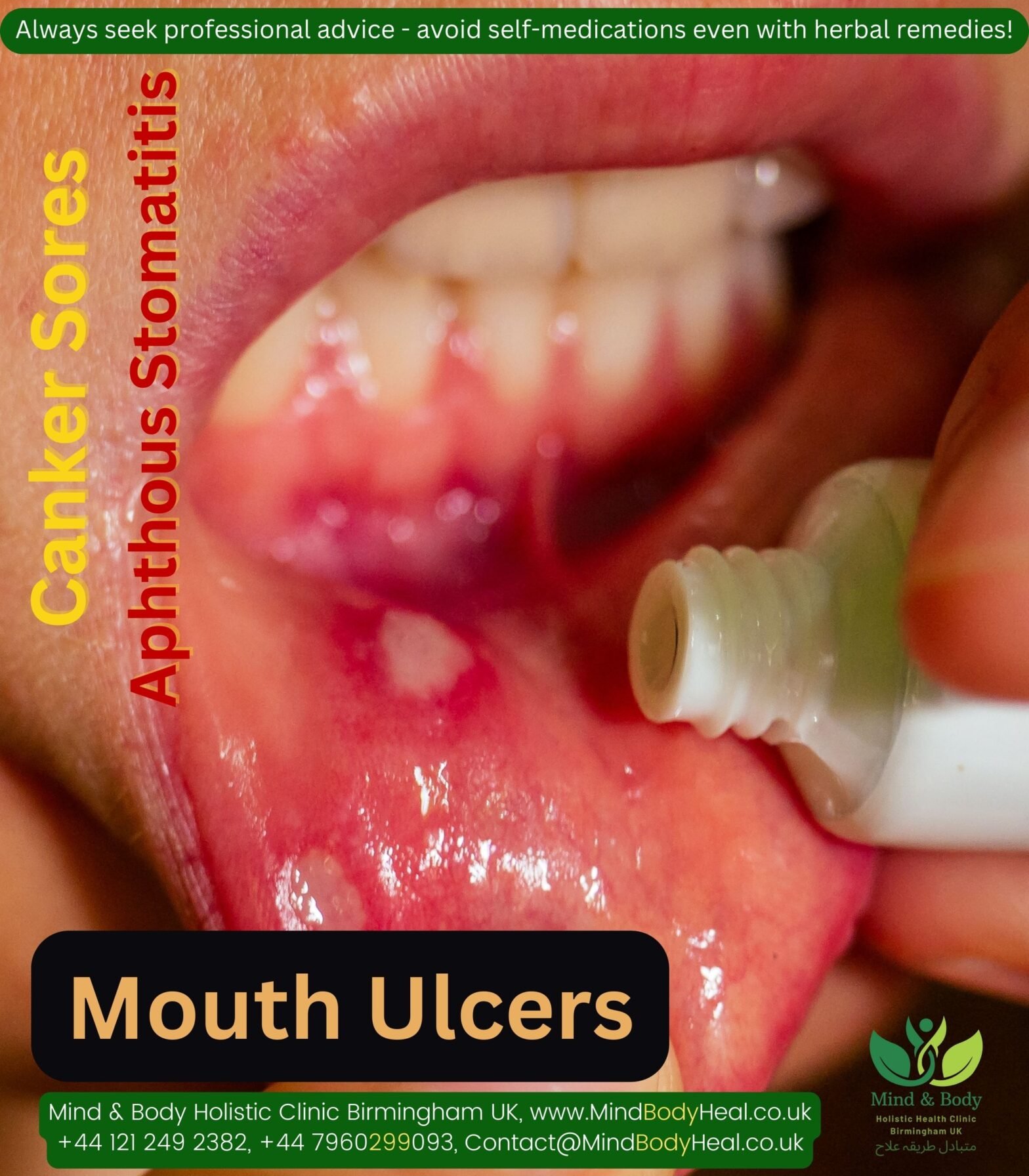 Canker Sores / Aphthous Stomatitis / Mouth Ulcers – Suggested ...
